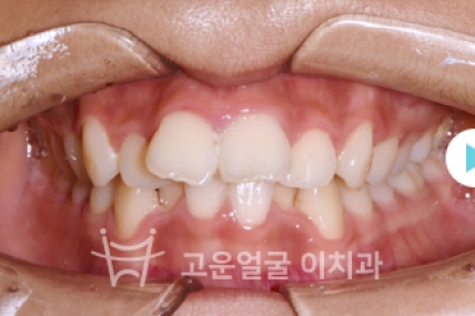 치료후기 이미지